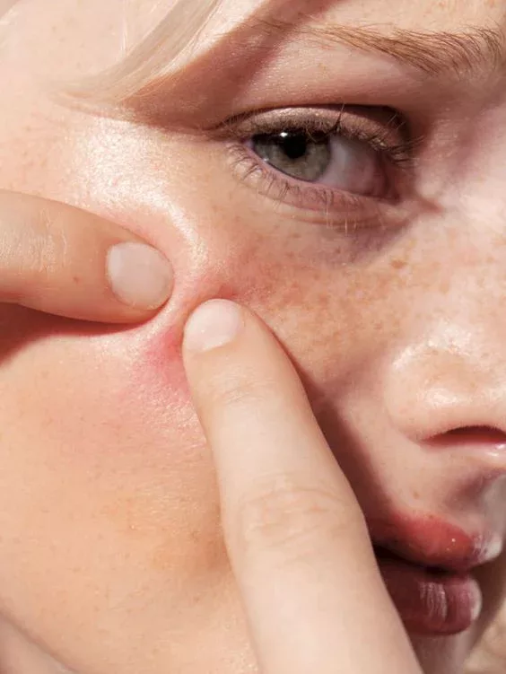 Acne & Acne Scarring
