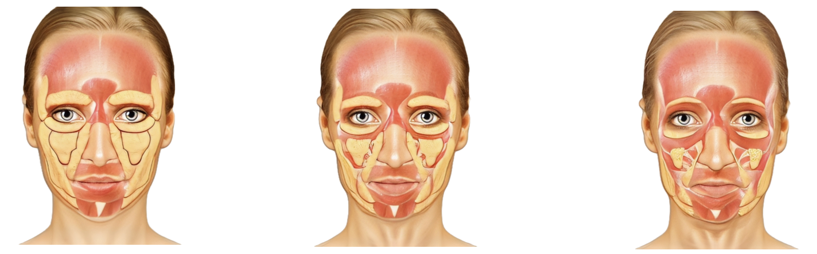 Loss of Facial Support