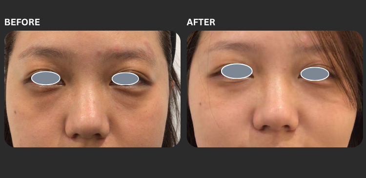 PRF eye Before & After