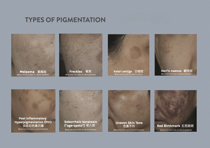 Laser Pigmentation Removal Adelaide: Best Treatment for Melasma & Dark Spots
