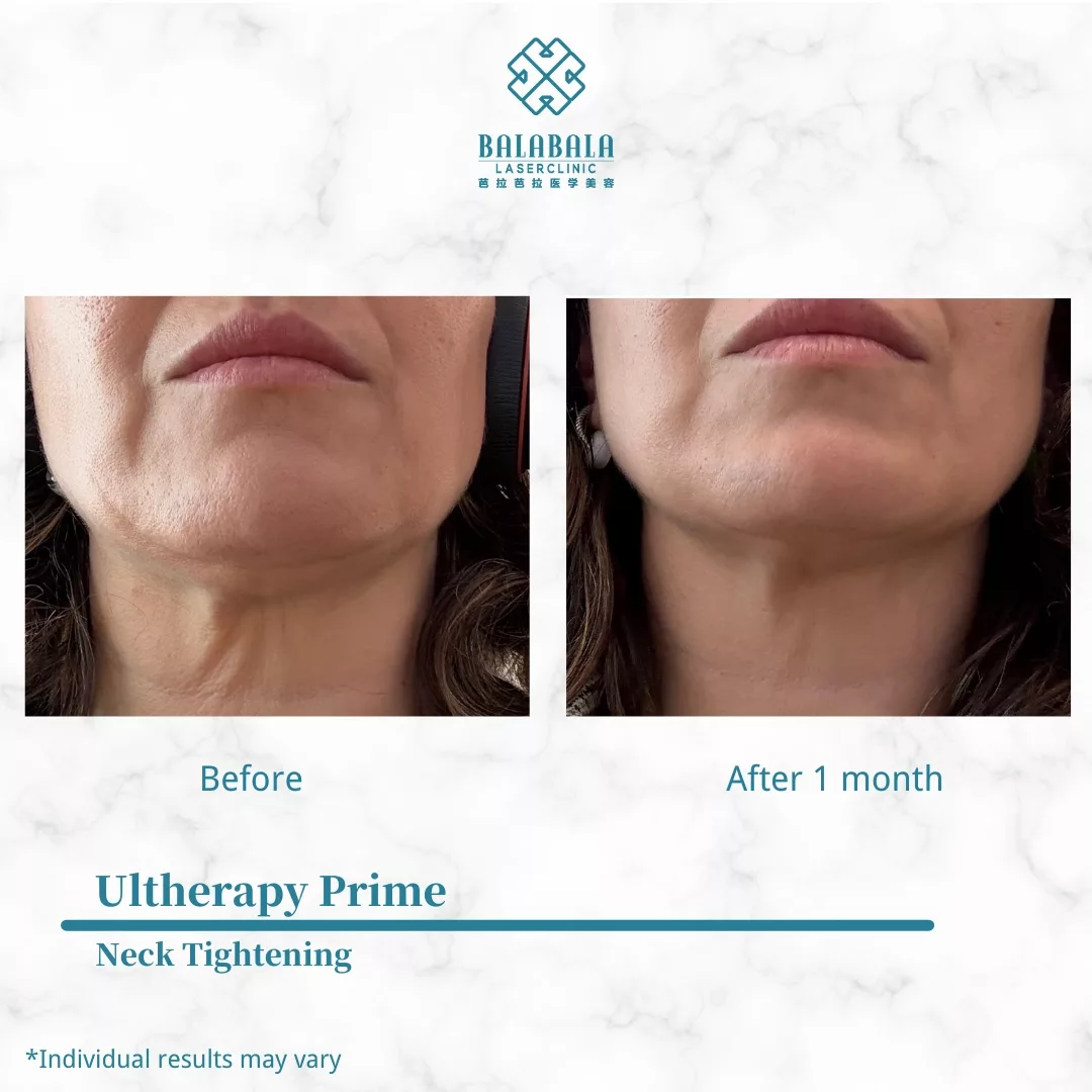 Ultherapy prime B&A