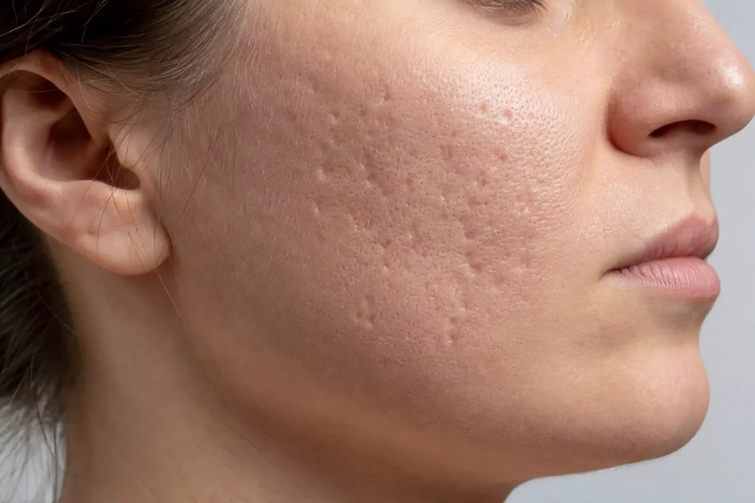 True atrophic acne scarring changes skin texture and depth—not only colour. Illustrative image.