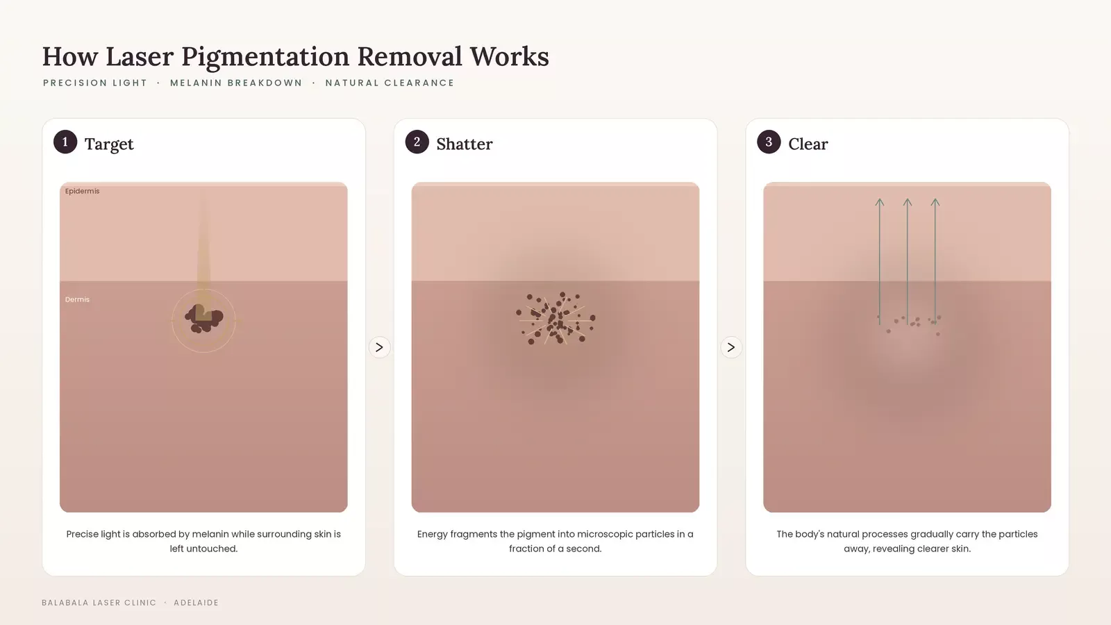 How dose laser pigmentation removal work
