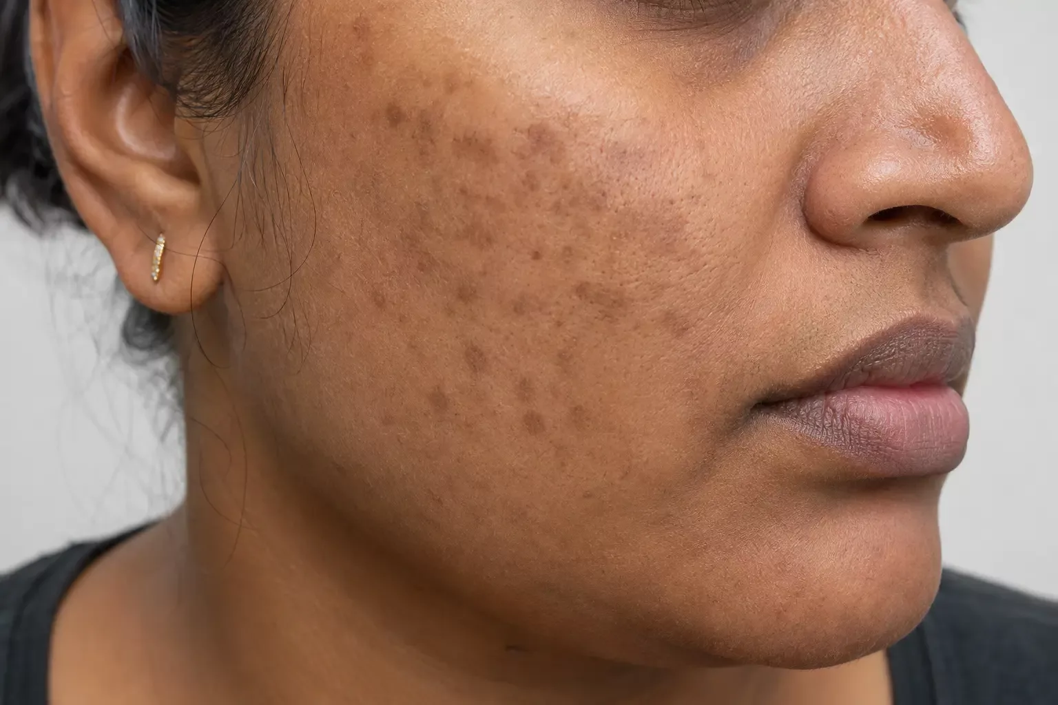 Melanin-based colour change; the surface remains flat.