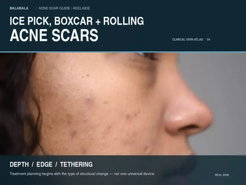 Ice Pick, Boxcar and Rolling Acne Scars: Why Treatment Must Match the Scar Type