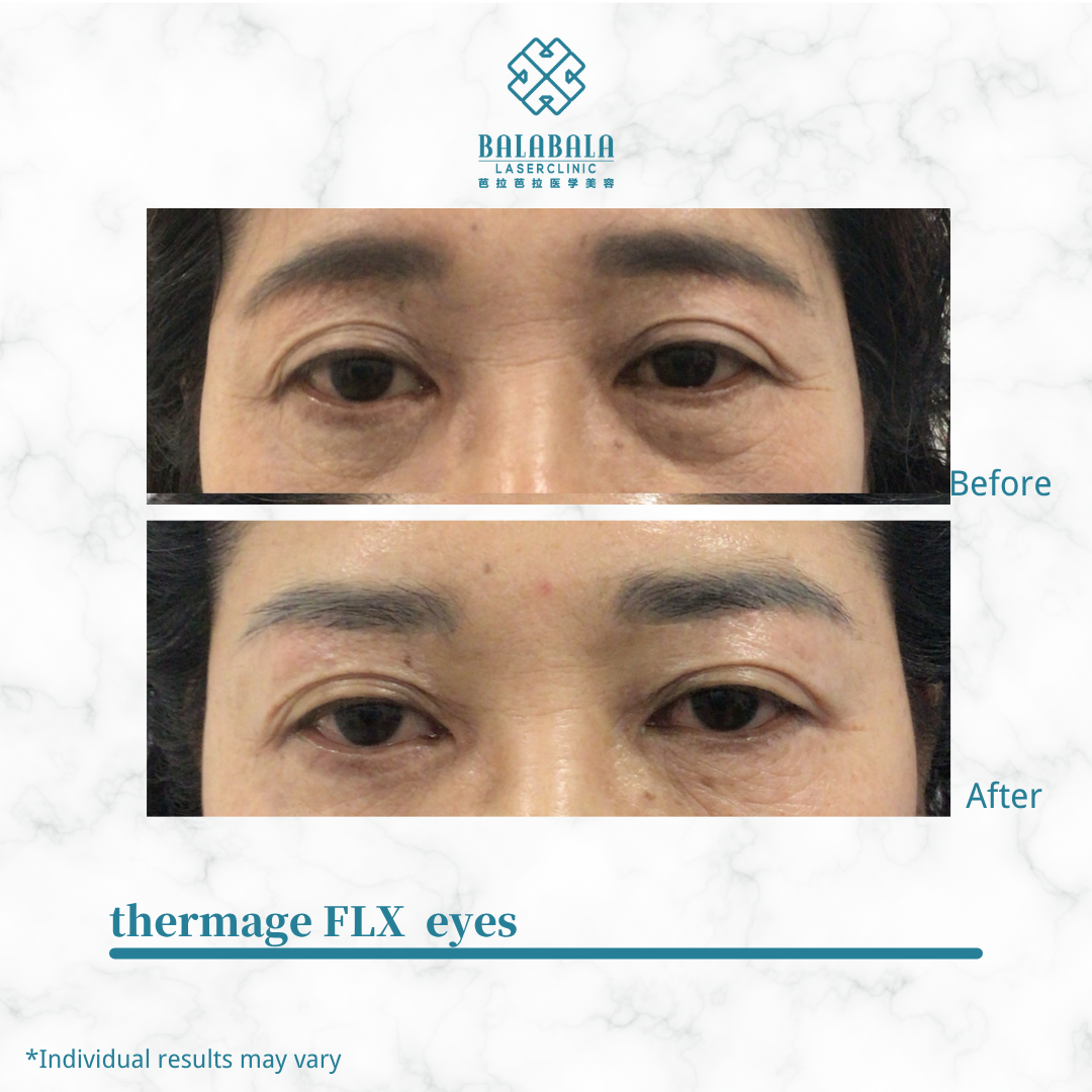 Thermage eye treatments before and after