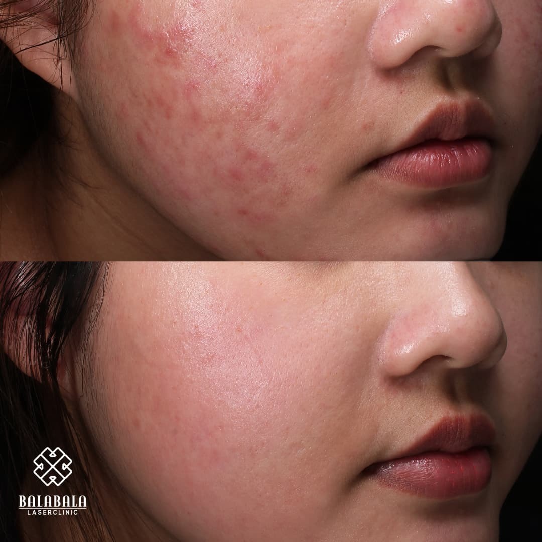 BalaBala Laser Clinc - Acne Before and After