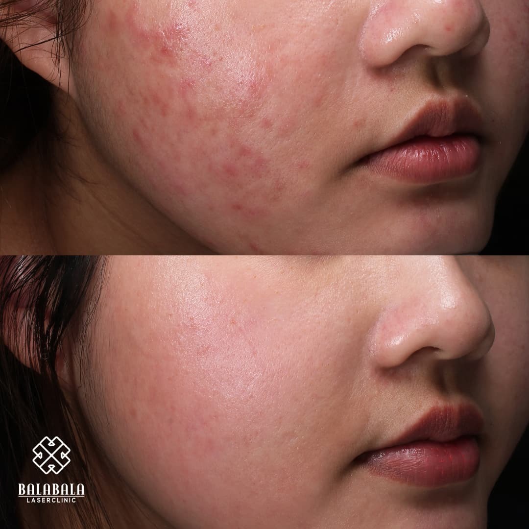 Acne before and after