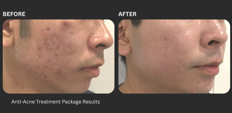 Fotona Acne Revision Laser 2