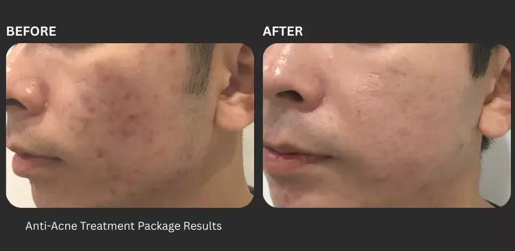 Fotona Acne Revision Laser