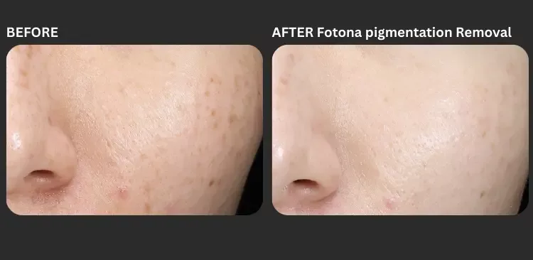 Fotona 3