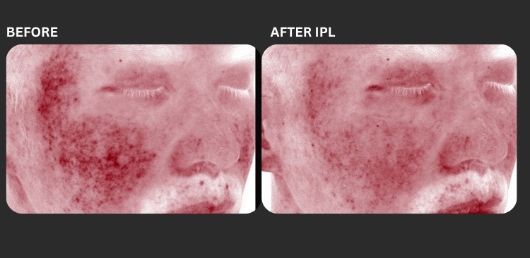 IPL before & after