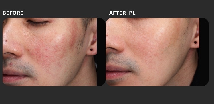 Icon IPL 3