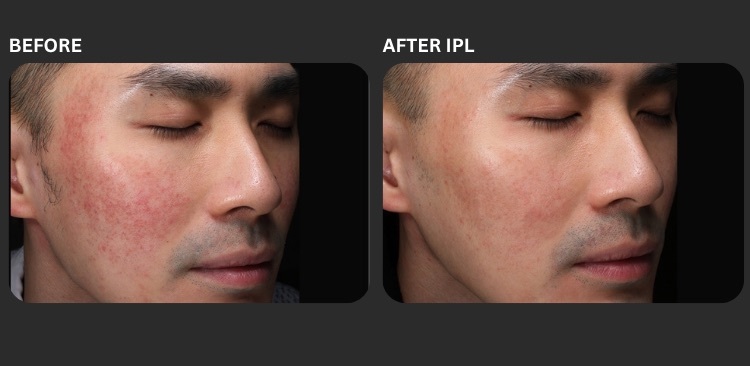 IPL before & after