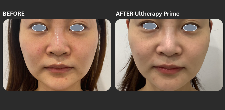 Ultherapy Prime 3