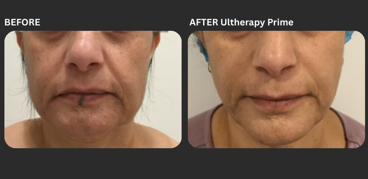 Ultherapy Prime 4