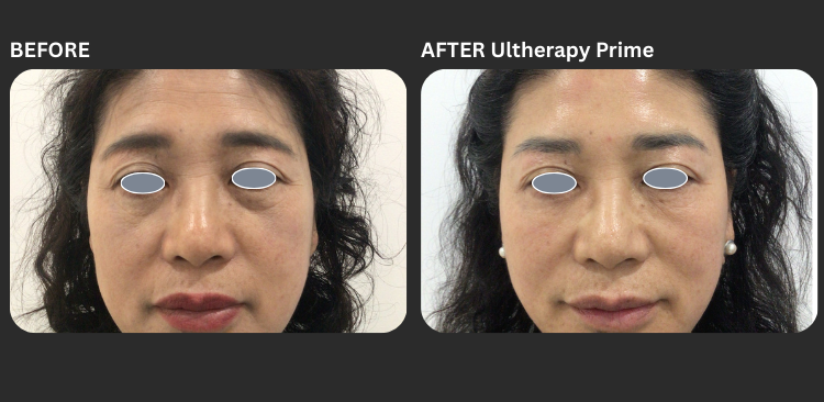 Ultherapy Prime