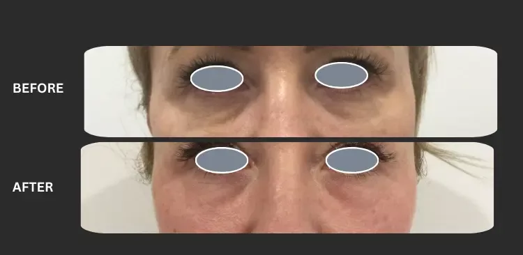 Fotona smooth eye 2