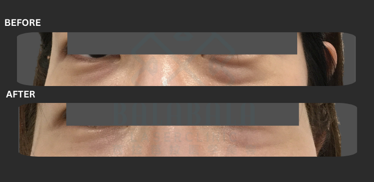 Fotona smooth eye BA