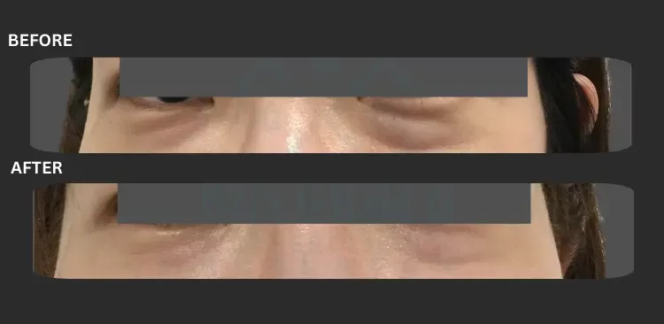 Fotona smooth eye BA