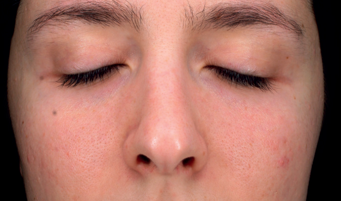 Mesopeel casos6a