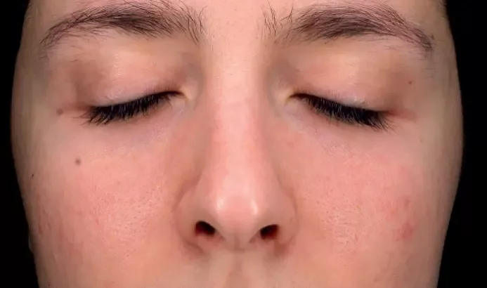 Mesopeel casos6a