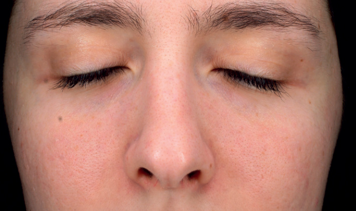Mesopeel casos6b