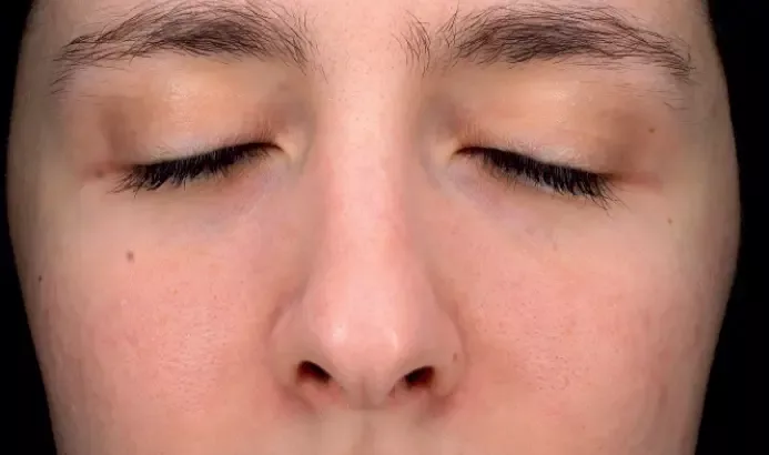 Mesopeel casos6b