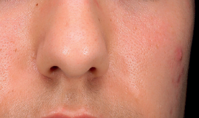 Mesopeel casos7a