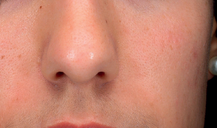 Mesopeel casos7b