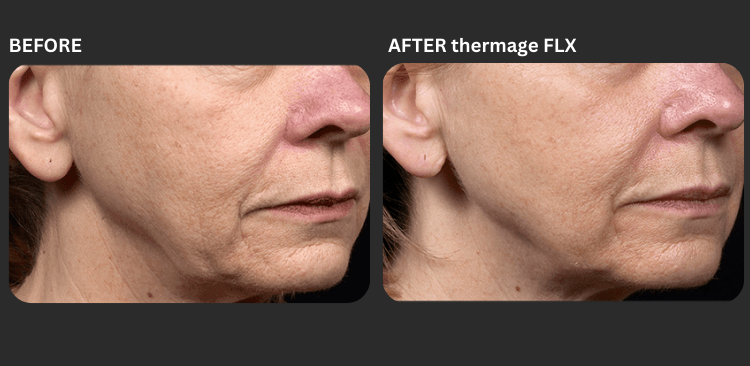 Thermage FLX 3