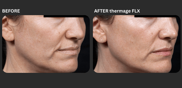 Thermage FLX 4
