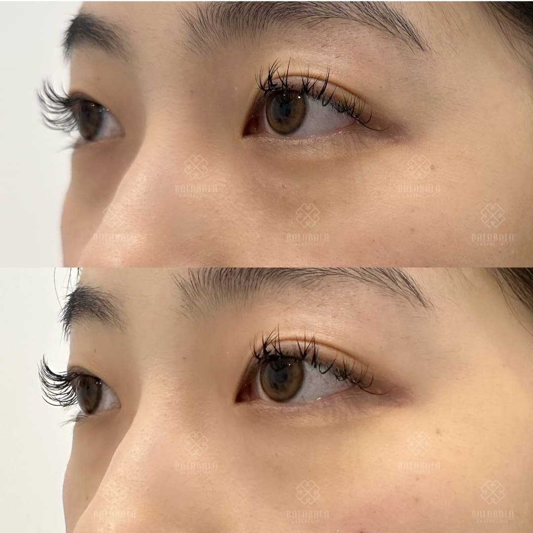 Teosyal Redensity 2 dark circle treatment