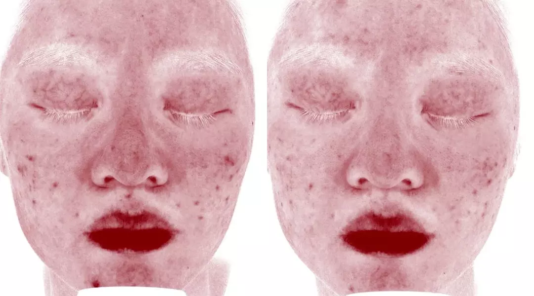 Post inflammatory erythema, Before and after