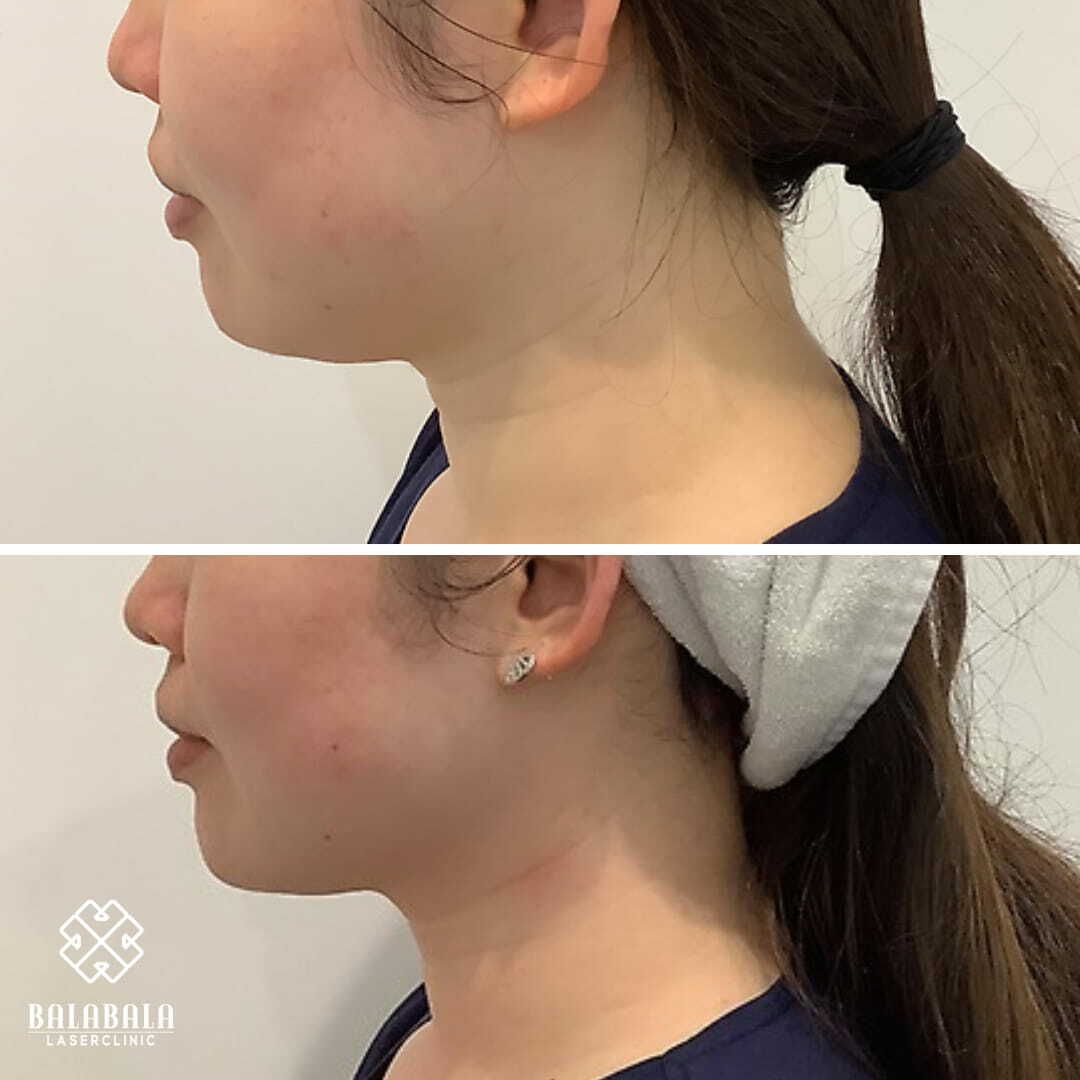 Q+ HIFU Fat dissolving