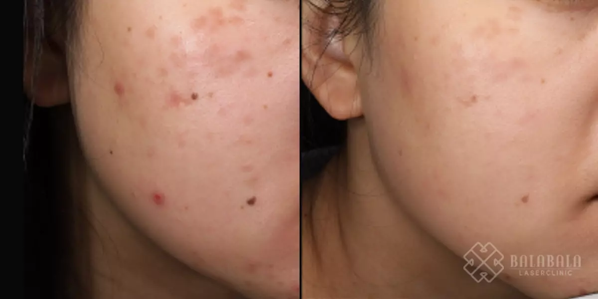 Post inflammatory hyperpigmentation, before and after