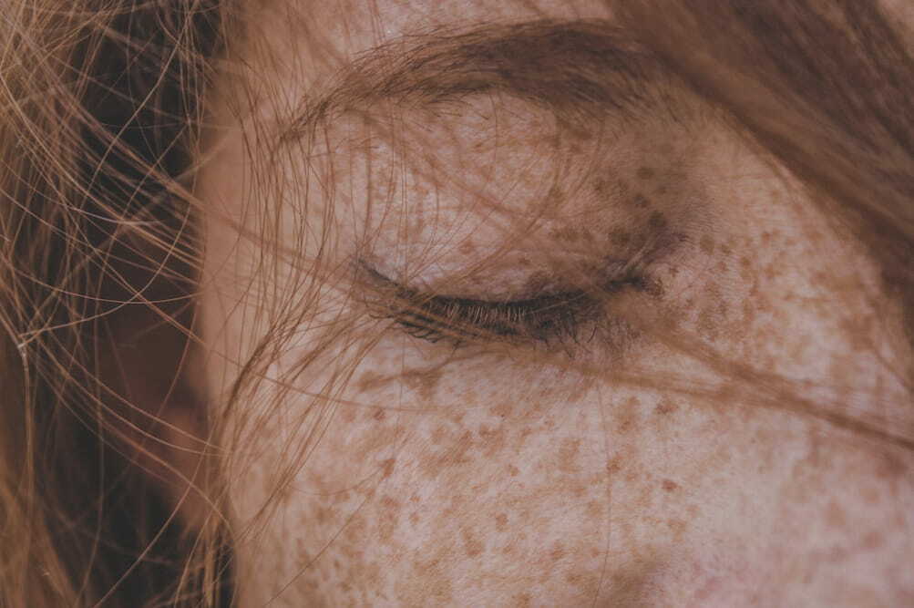 BalaBala Laser Clinc - Pigmentation freckles