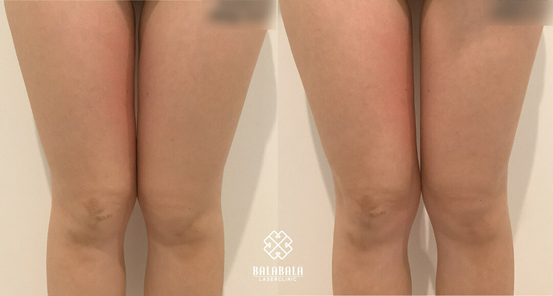 BalaBala Laser Clinc - Alma Accent Prime Before and After - Legs