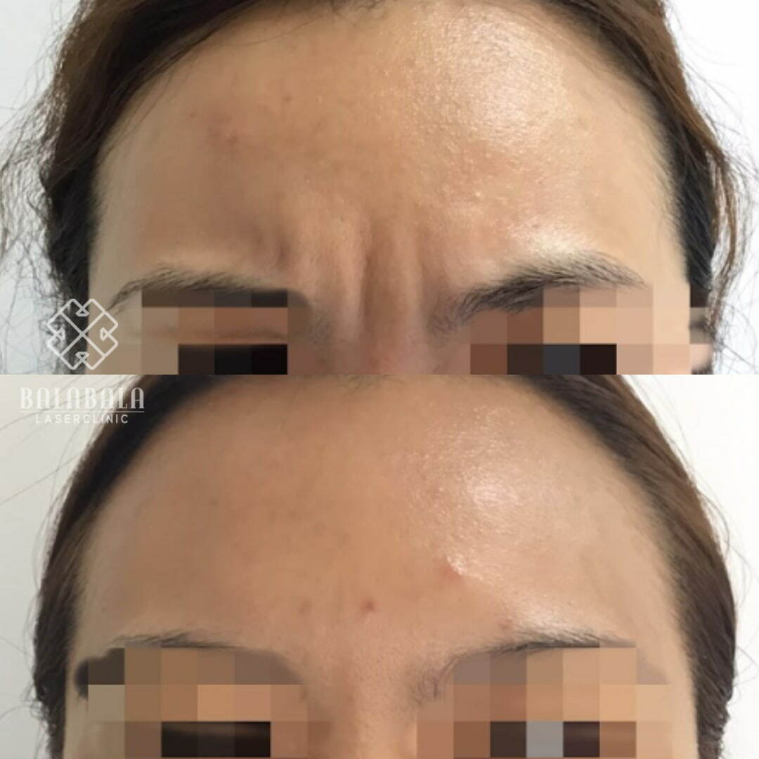 BalaBala Laser Clinc - anti-wrinkle- frown lines