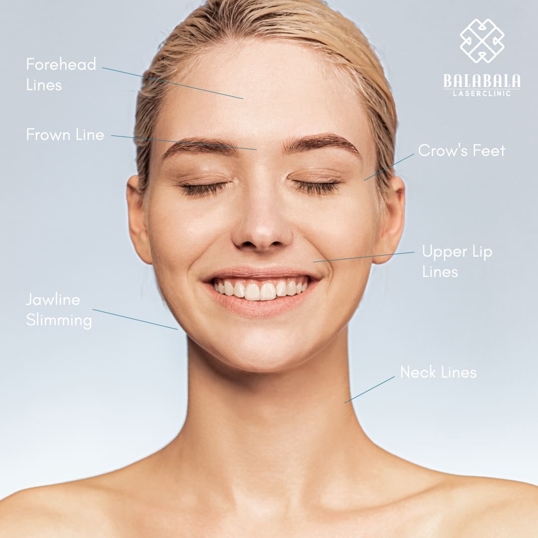 BalaBala Laser Clinc - anti-wrinkle injection facial map