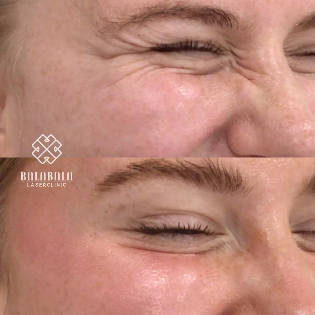 BalaBala Laser Clinc - Anti wrinkle injections - crow's feet before and after