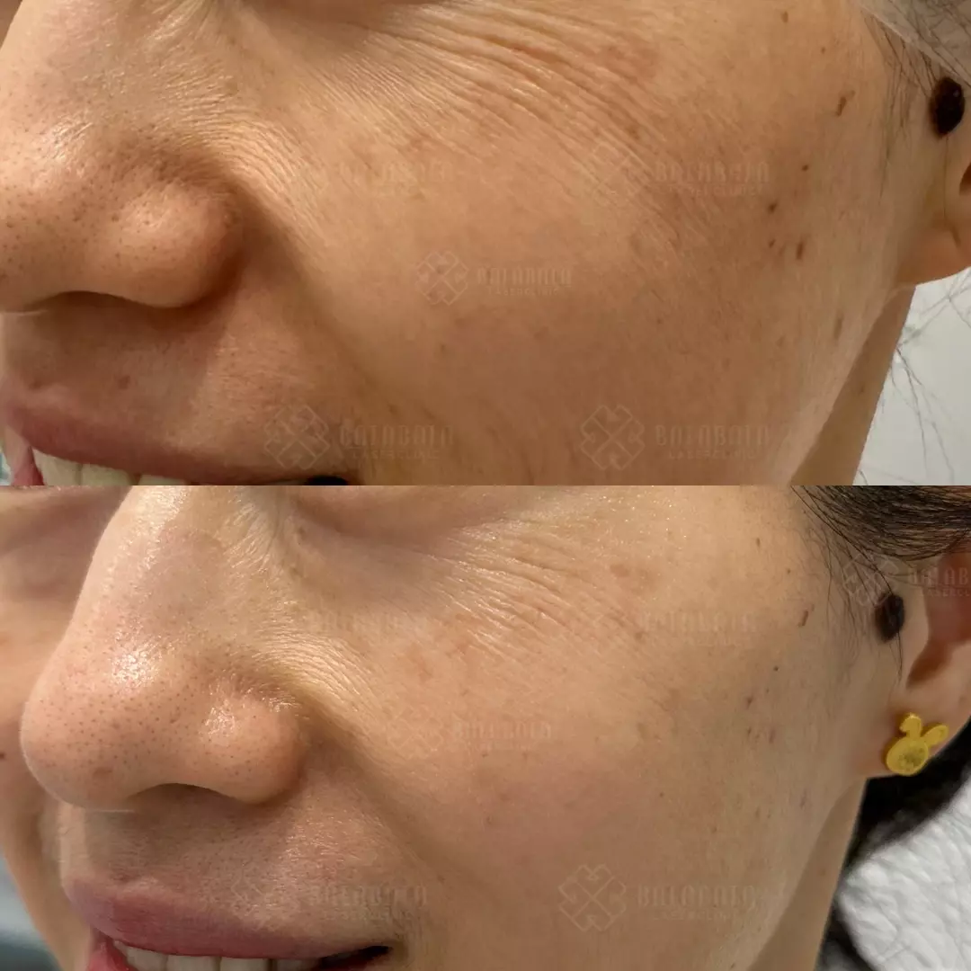 Bio-remodelling injections, before and after