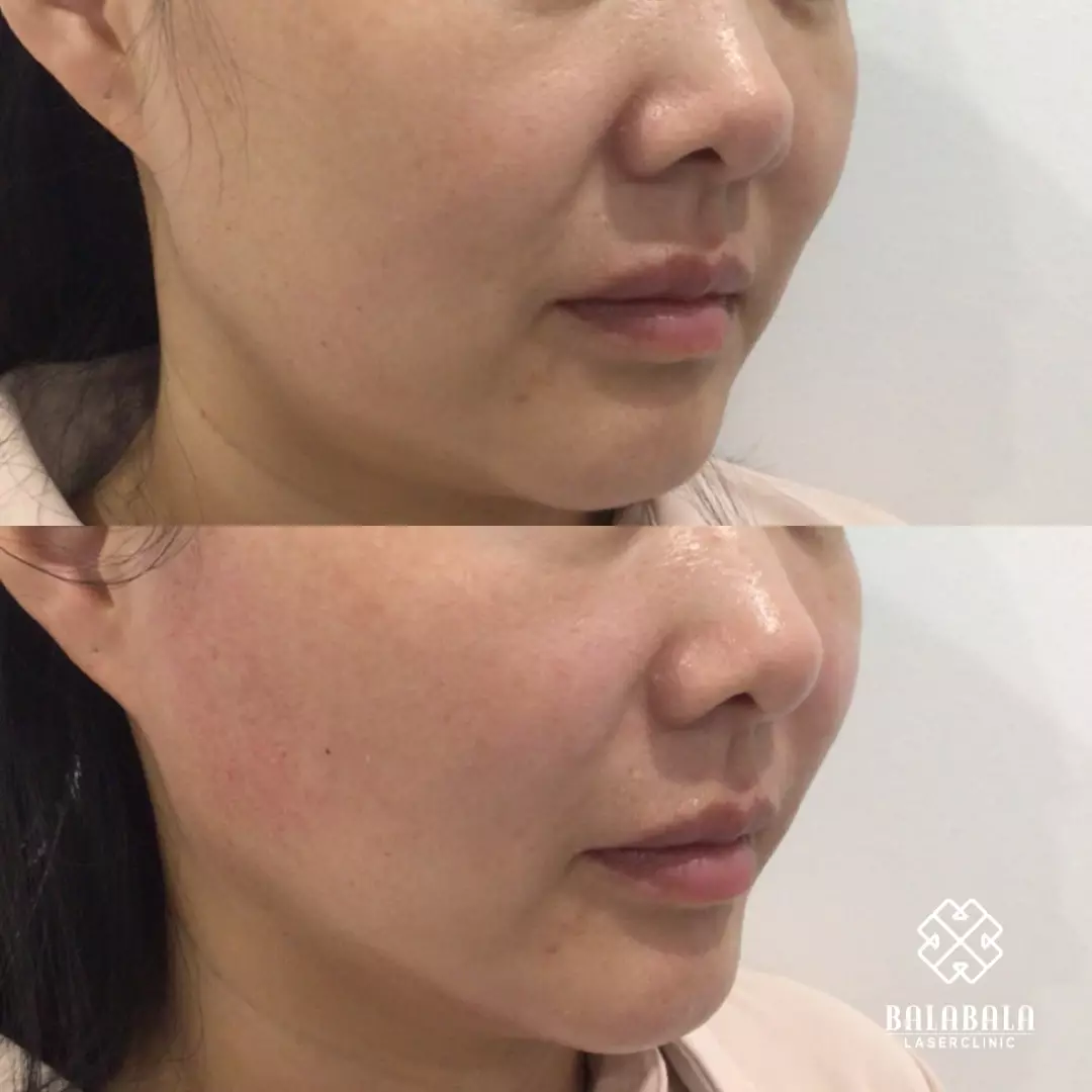 BalaBala Laser Clinc - Collagen stimulator injection, before and after