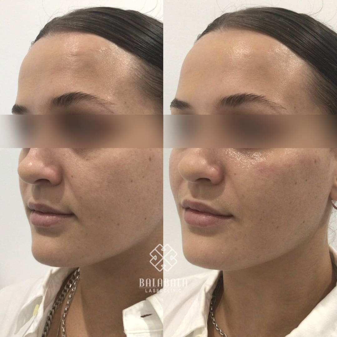 BalaBala Laser Clinc - Dermal fillers for cheeks