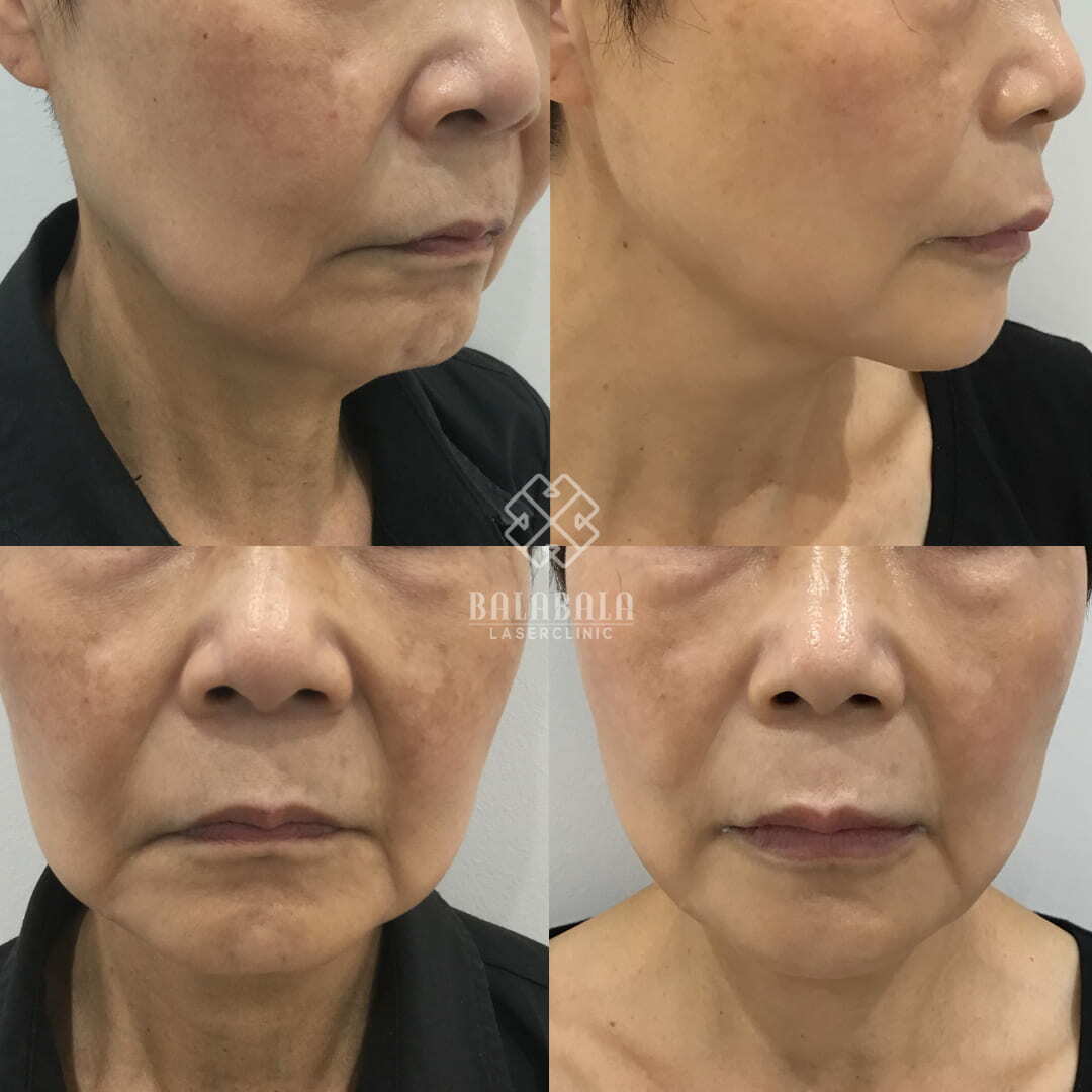 Cosmetic Injections for Sagging Jowls, Before and After