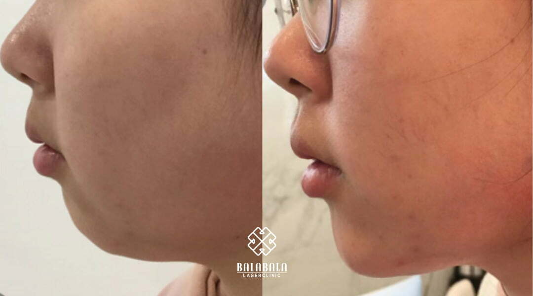BalaBala Laser Clinc - Masster injections combined with chin filler