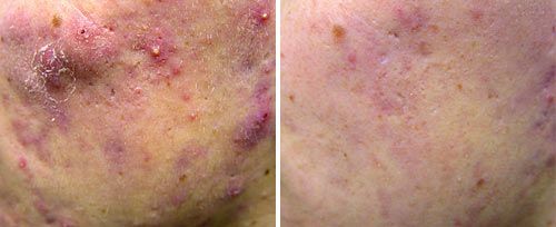 Fotona Acne Revision Before and After