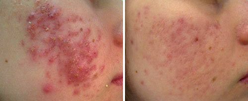 Fotona Acne Revision Before and After 1