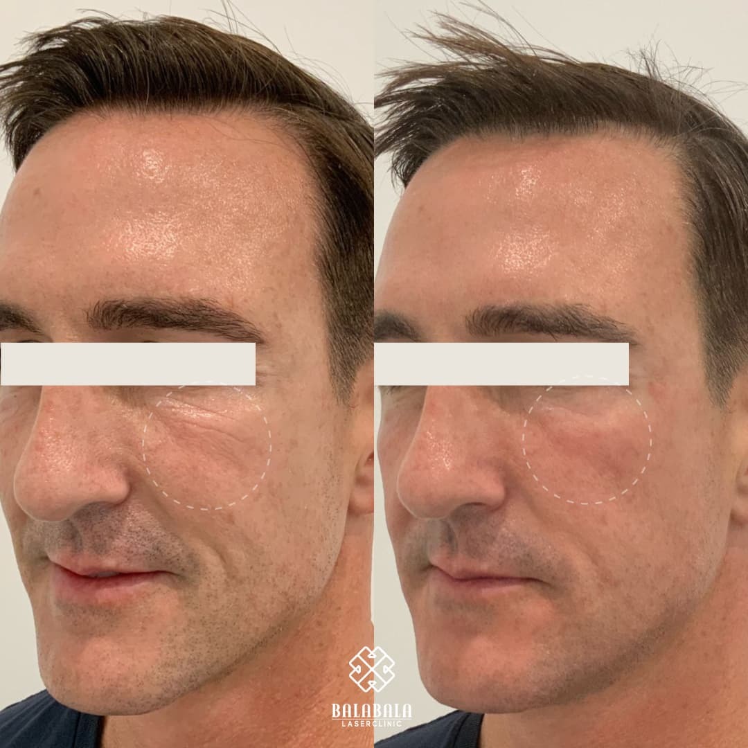 BalaBala Laser Clinc - Fotona 4D Before and After