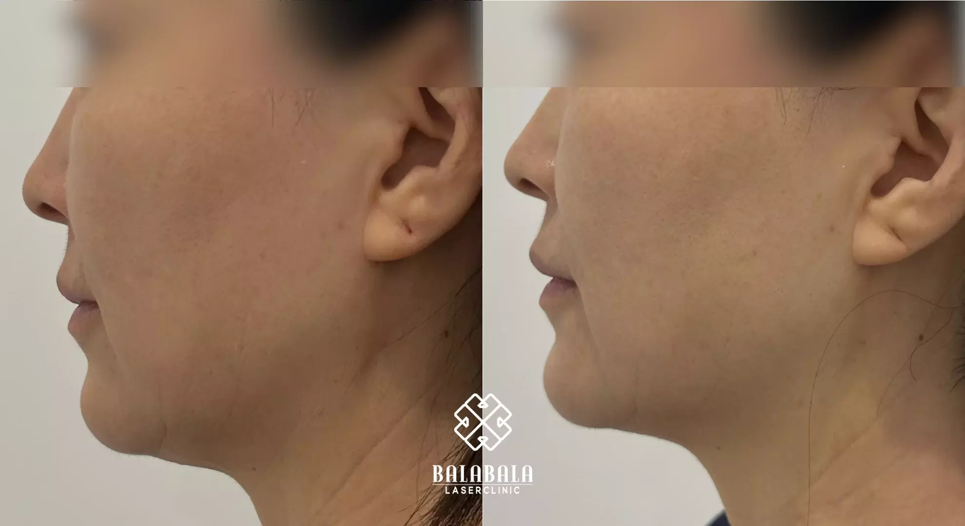 BalaBala Laser Clinc - Fotona 6D laser skin rejuvenation